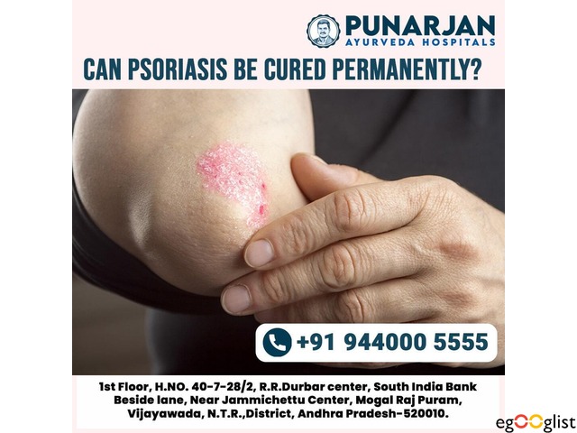 Best Psoriasis Treatment in Vijayawada